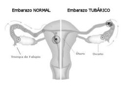 Aborto tubárico